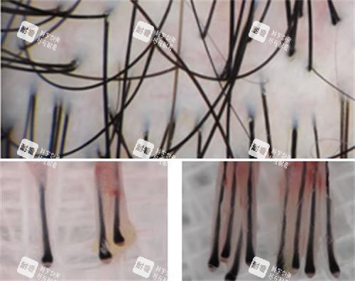 頭皮放大毛囊細(xì)節(jié)圖