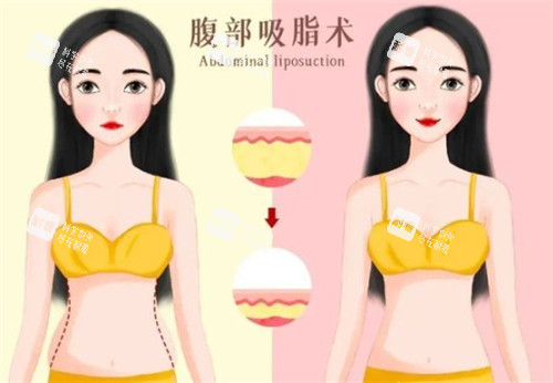 宋建星醫(yī)生吸脂怎么預(yù)約？線上+線下全攻略+2025吸脂全新價(jià)格表