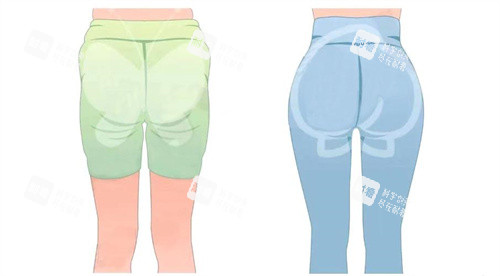 臀部吸脂手術(shù)背面對(duì)比動(dòng)畫(huà)圖