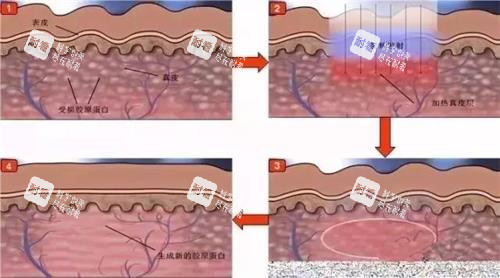 光子嫩膚的步驟