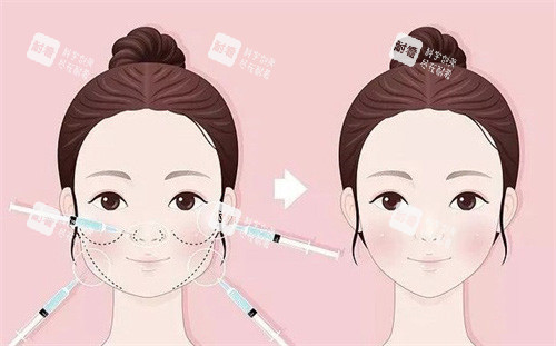 饅化針注射照片