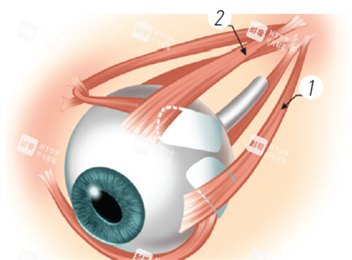 后鞏膜加固術(shù)演示