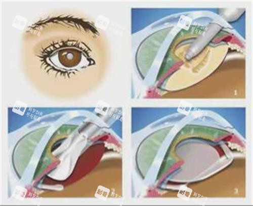 后鞏膜加固術(shù)的步驟
