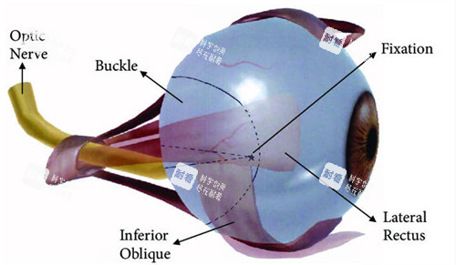 后鞏膜加固術(shù)動(dòng)畫圖