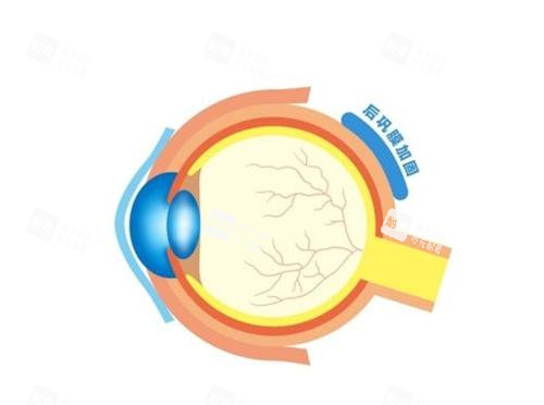 后鞏膜加固的部位 后鞏膜加固的部位