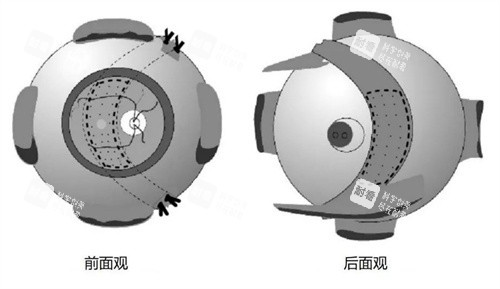 后鞏膜加固 后鞏膜加固