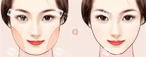 面部吸脂 面部吸脂