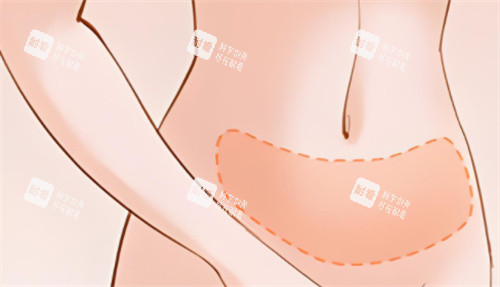 吸脂腹部區(qū)域 吸脂腹部區(qū)域