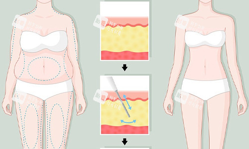 全身吸脂展示圖 全身吸脂展示圖