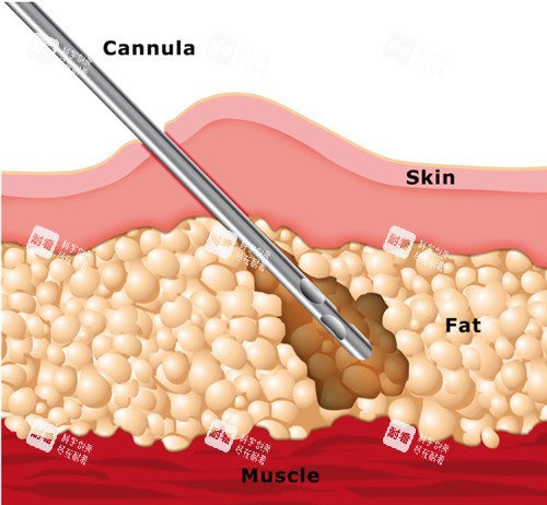 吸脂手術(shù)動畫演示 吸脂手術(shù)動畫演示