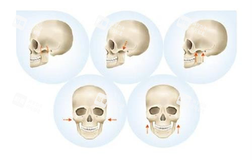 磨骨手術手術過程