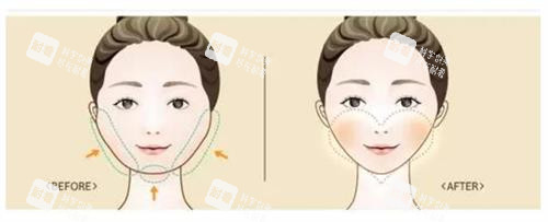 磨骨手術前后的區(qū)別