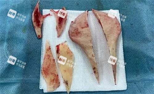 磨骨手術切掉的骨頭