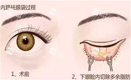 內(nèi)切法祛眼袋手術(shù)