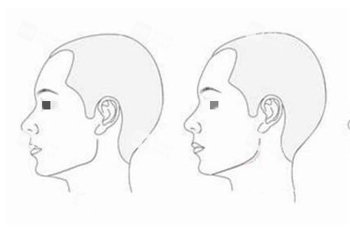 磨骨前后對比圖