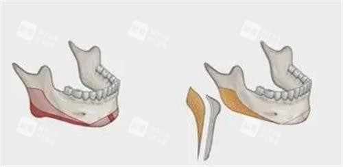 削骨磨骨示意圖