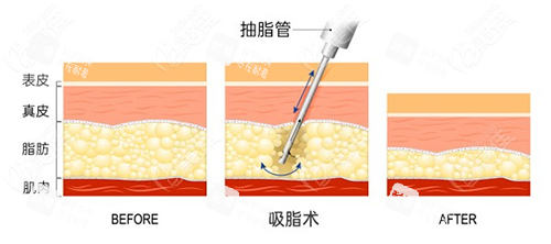 吸脂手術方法