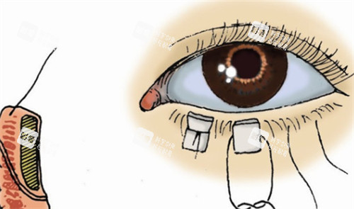 下眼瞼外翻修復(fù)過(guò)程