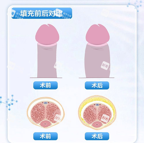 填充增大增粗示意圖 填充增大增粗示意圖