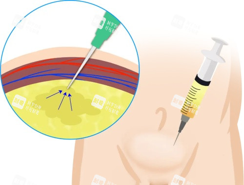 玻尿酸增粗 玻尿酸增粗