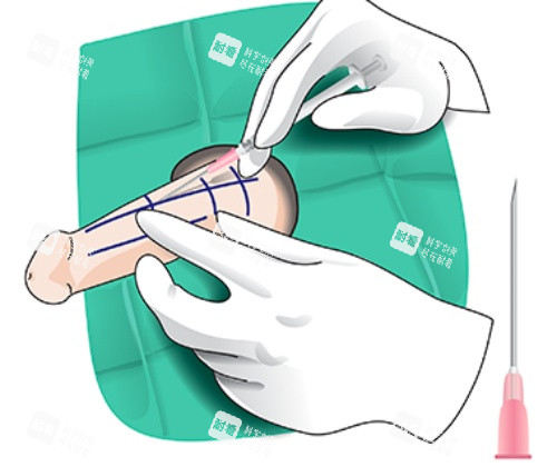 玻尿酸增粗漫畫示意圖