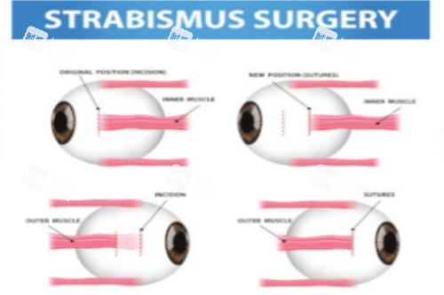 斜視手術(shù)前后對(duì)比