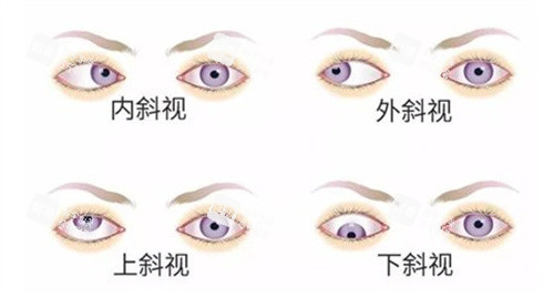 內(nèi)外斜視、上下斜視