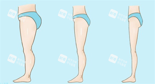 腿部吸脂瘦身前后