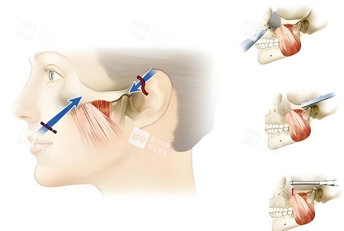 顴骨內(nèi)推手術(shù)原理動(dòng)畫圖 顴骨內(nèi)推手術(shù)原理動(dòng)畫圖