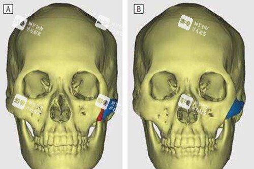 顴骨內(nèi)推示意圖 顴骨內(nèi)推示意圖