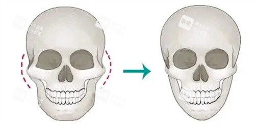 顴骨內(nèi)推手術(shù) 顴骨內(nèi)推手術(shù)