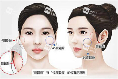 顴骨高突出演示動(dòng)畫圖 顴骨高突出演示動(dòng)畫圖