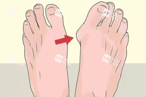 大腳骨整形前后對比圖