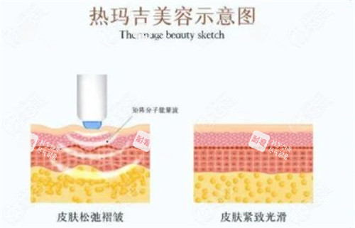 熱瑪吉美容示意圖