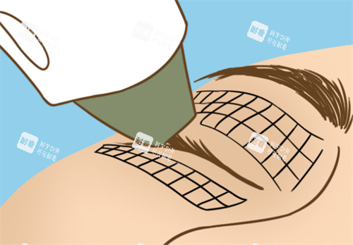 熱瑪吉眼部抗衰過程圖解