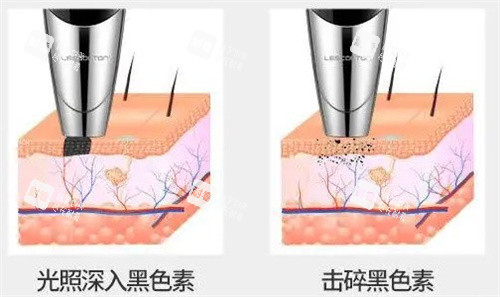 激光去紋身 激光去紋身