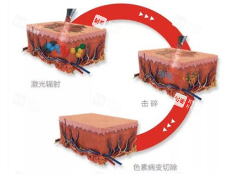 去紋身原理 去紋身原理