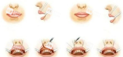 厚唇改薄后悔一輩子？揭秘手術(shù)背后的真相，這些坑千萬(wàn)別踩！