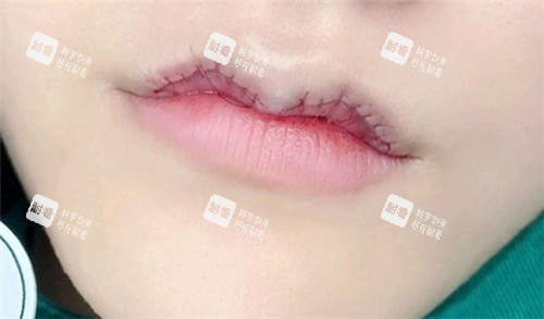 微笑唇手術(shù)縫合圖片