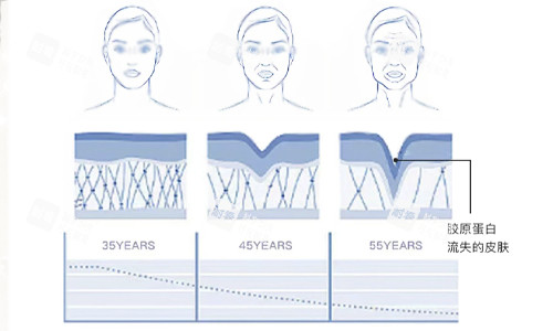 膠原蛋白流失的皮膚