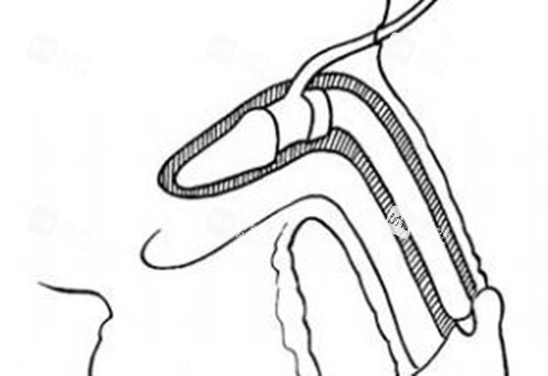 男性私密整形假體植入陰莖卡通示意圖