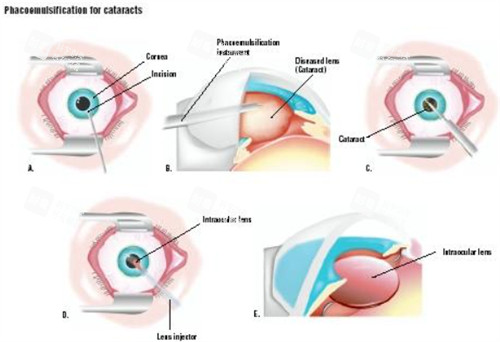 超聲乳化白內(nèi)障吸除術(shù)過(guò)程