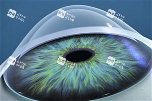 清晰的圓錐角膜示意圖