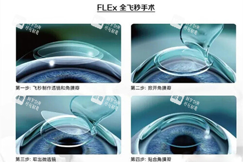 全飛秒手術(shù)過(guò)程示意圖