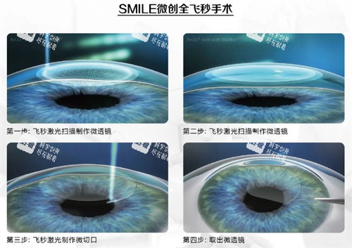 全飛秒手術(shù)過(guò)程
