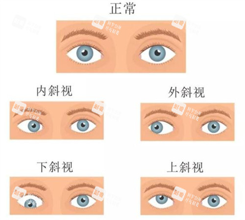 不同情況的斜視眼睛