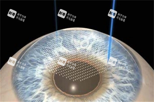 全飛秒激光手術(shù) 全飛秒激光手術(shù)