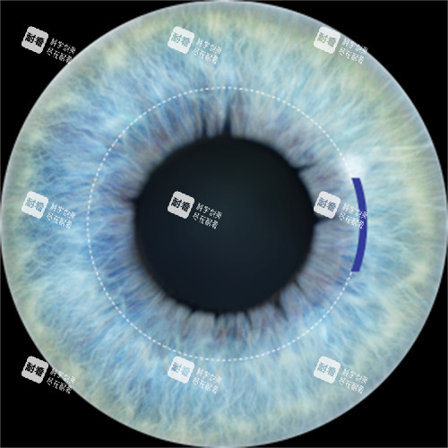 全飛秒手術(shù)切口展示 全飛秒手術(shù)切口展示
