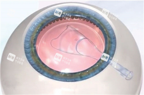 植入ICL晶體示意圖