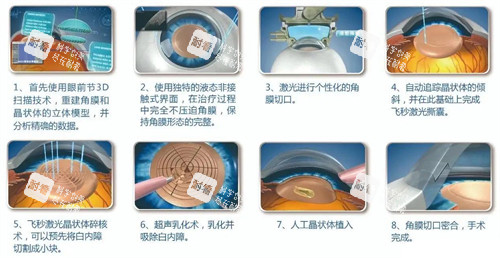 何氏眼科白內(nèi)障手術(shù)真人實測！從術(shù)前檢查到術(shù)后修復(fù)，超詳細(xì)避坑指南來了！